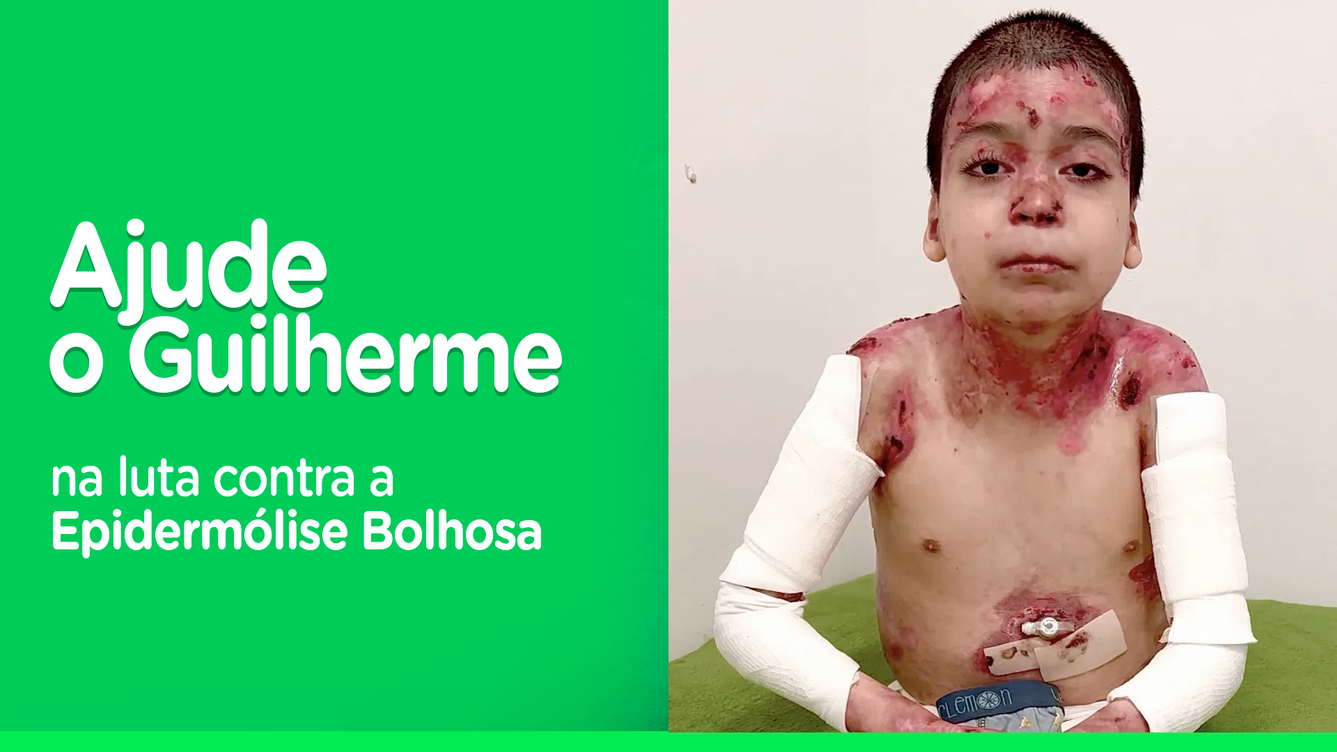 Ajude o Guilherme. Ele vive com uma doença rara e dolorosa.
